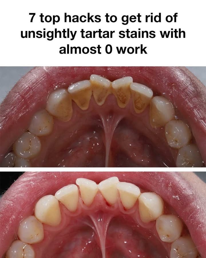 Say Goodbye to Stubborn Tartar: 7 Low-Effort Hacks That Actually Help Dissolve Those Yellow Stains