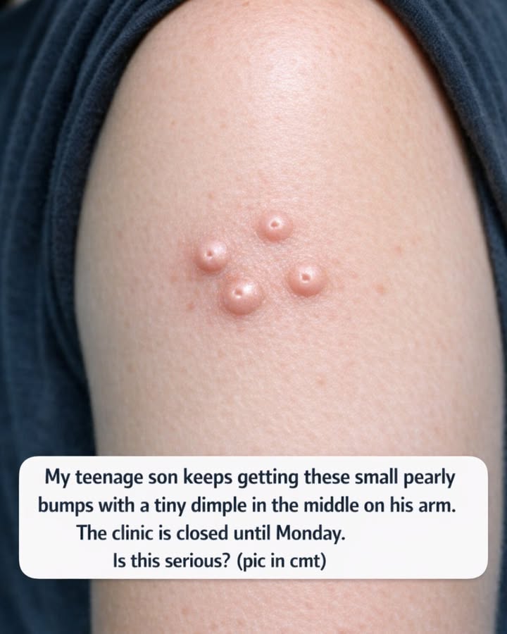 Small Pearly Bumps With a Tiny Dimple in the Middle? What Parents Should Know Before Monday's Clinic Visit