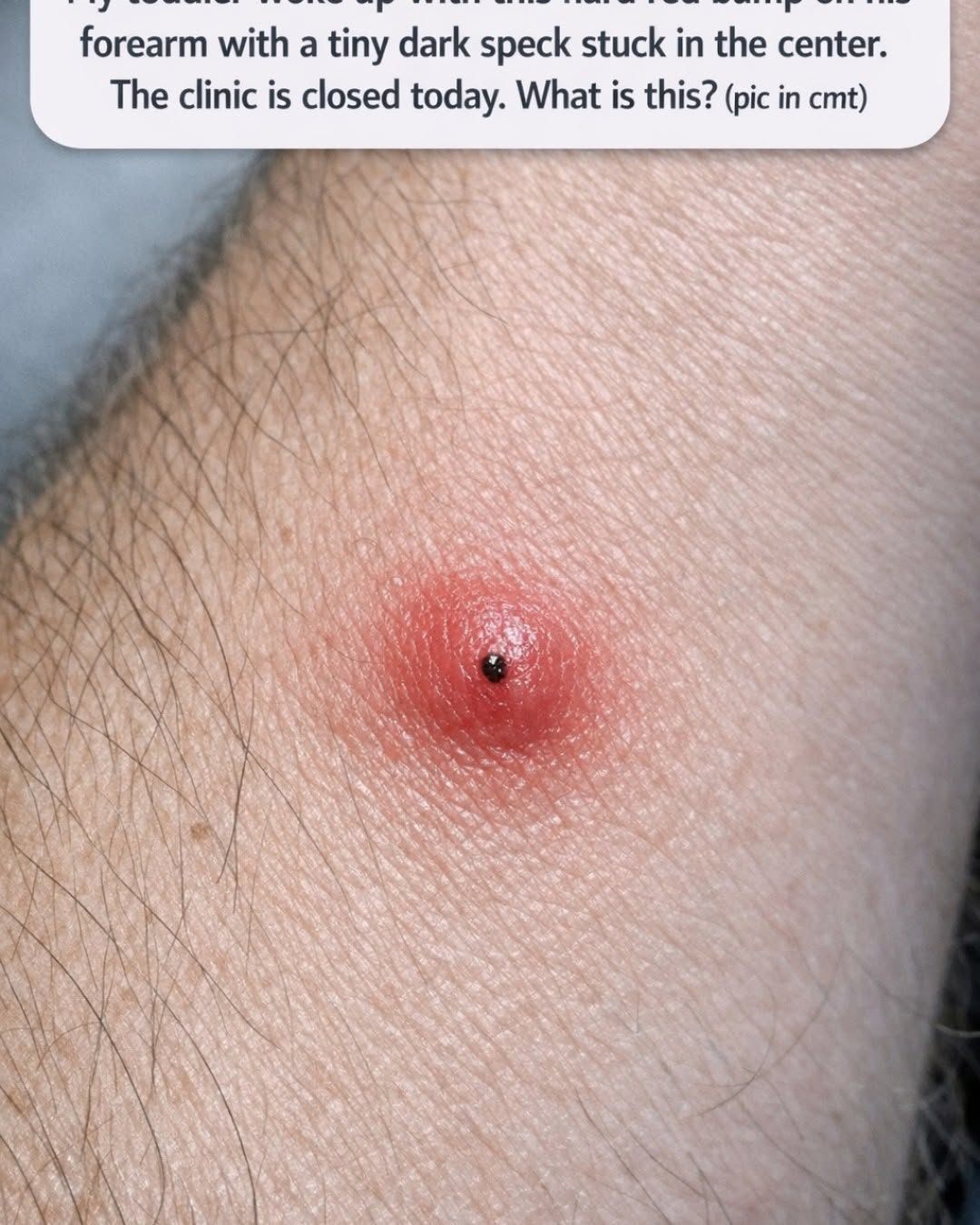 Found a Red Bump With a Dark Speck on Your Child's Skin? Read This Before the Clinic Opens