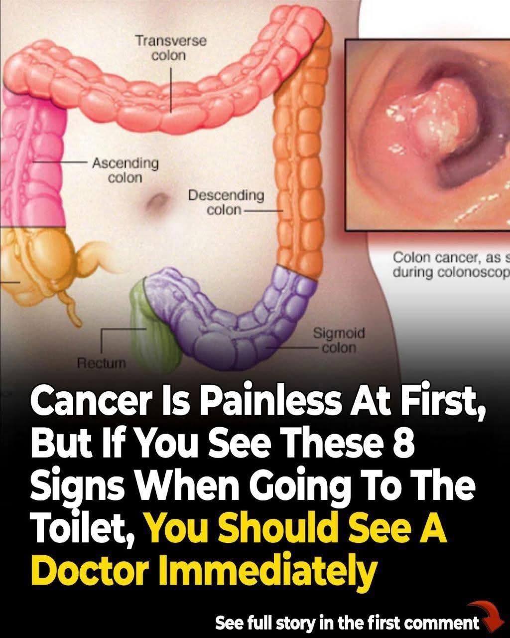 Your Bathroom Habits Could Be Flagging Colon Cancer Years Before Diagnosis - The Signs Doctors Ask About