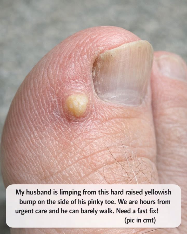Hard Yellow Bump on Your Pinky Toe? Fast At-Home Relief When the Clinic Is Hours Away
