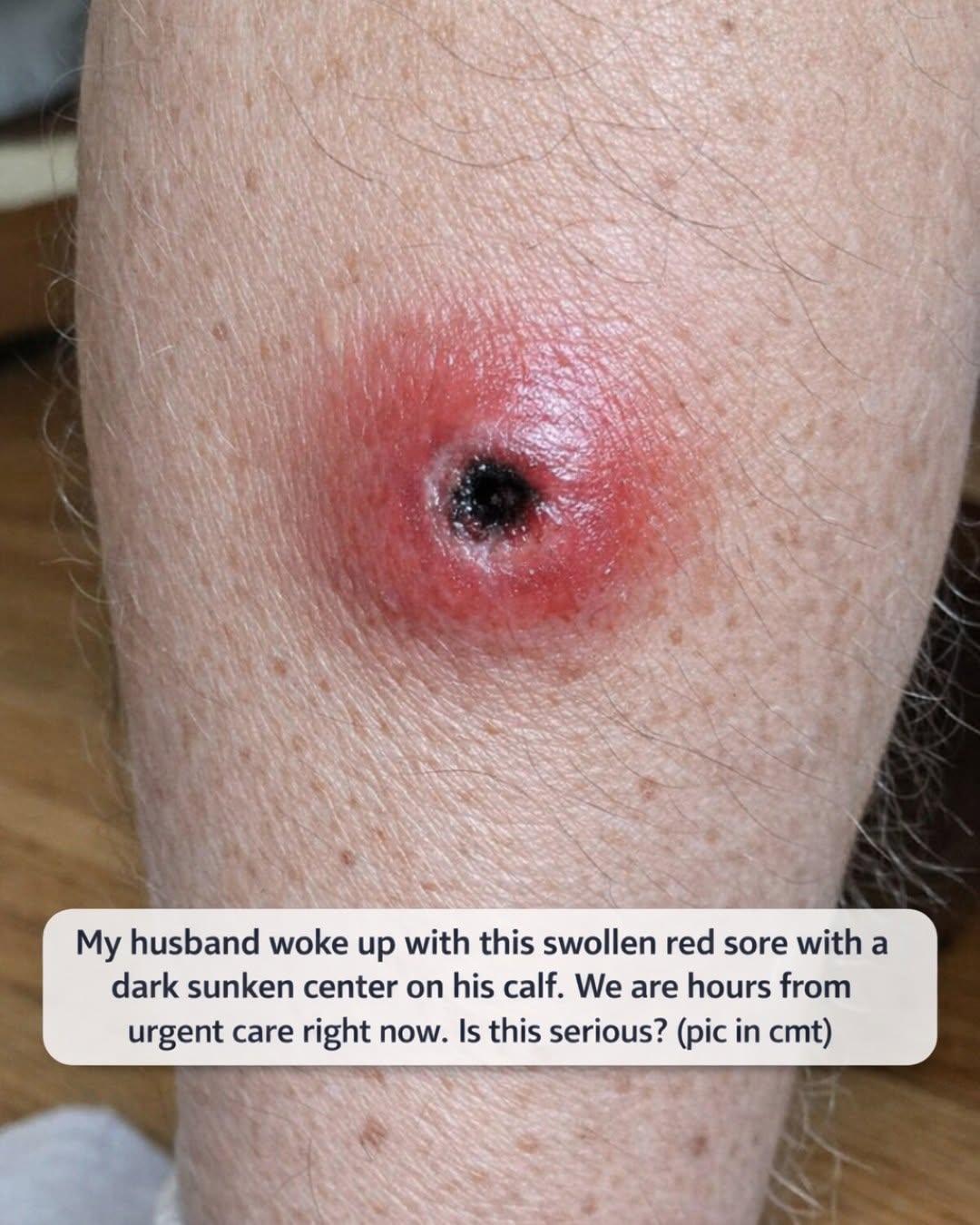Swollen Red Sore With a Dark Sunken Center on the Leg: When You Really Do Need to Drive to Urgent Care