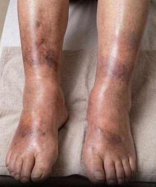 Swollen Legs Are Usually Harmless - but Doctors Warn This One Pattern Could Signal Pancreatic Cancer