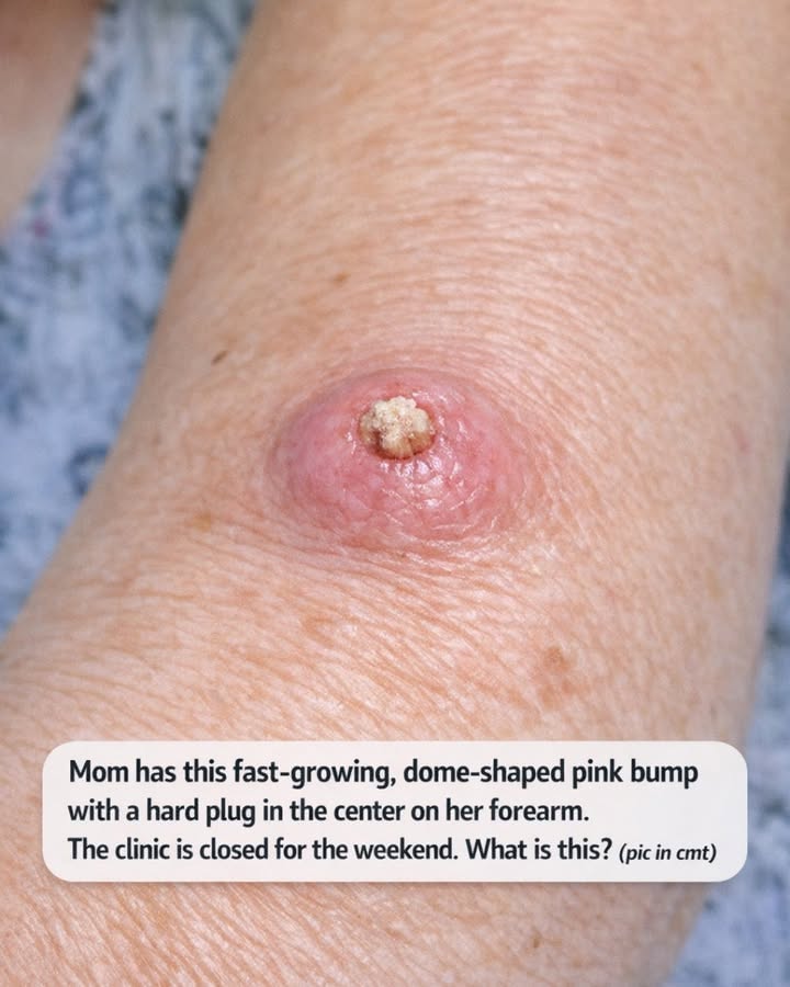 Fast-Growing Pink Bump With a Hard Center Plug on Your Arm? Why Doctors Say Never Wait It Out Over a Weekend