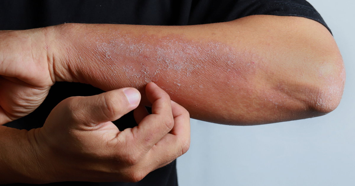 Those Painful Little Blisters On Your Hands Could Be Dyshidrotic Eczema - Here Is What Helps